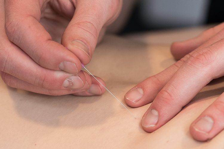 Dry-needling Fysiofitt